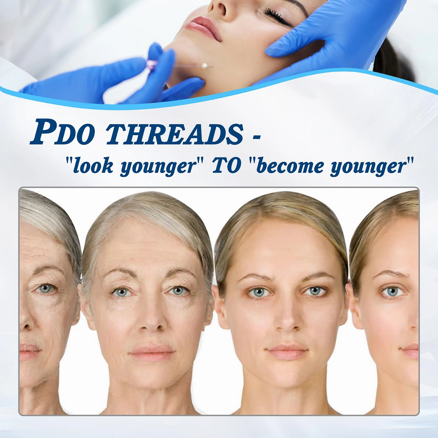 Pdo Threads for Face Lift Mono Screw Type (30g38MM) Smoothing Wrinkles PDO Thread Lift for Whole Body with Sharp Tip 20pcs